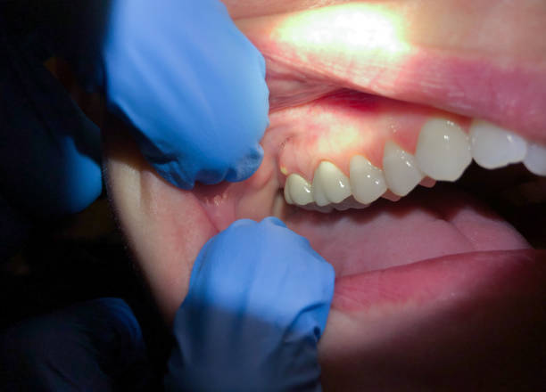 Best Emergency Care for Gum Disease in Jonesville, LA