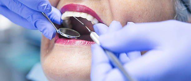Best Emergency Wisdom Tooth Extraction in Jonesville, LA
