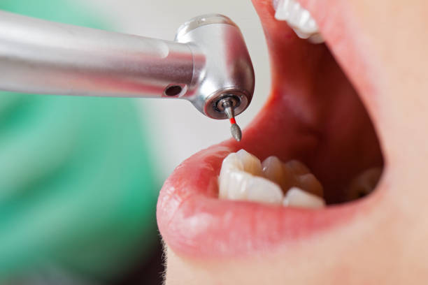 Best Dental Abscess Treatment in Jonesville, LA